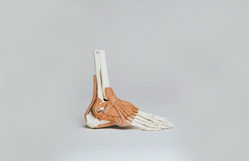 Sprained Ankle